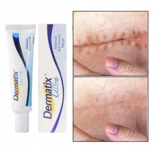 Dermatix Ultra, Gel za liječenje i prevenciju ožiljaka, 15g
